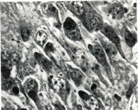 Многочисленные тельца Бабеша — Негри (в виде гранул черного цвета) в секторе Зоммера гиппокампа (окраска по Манну; ЧХ400).